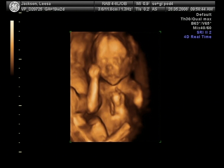 3d ultrasound pictures of twins. I had my 3d at 19 weeks and 3